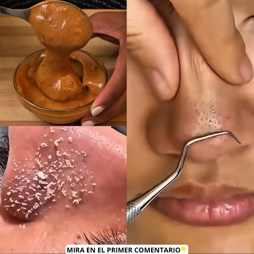 Mascarilla casera para puntos negros