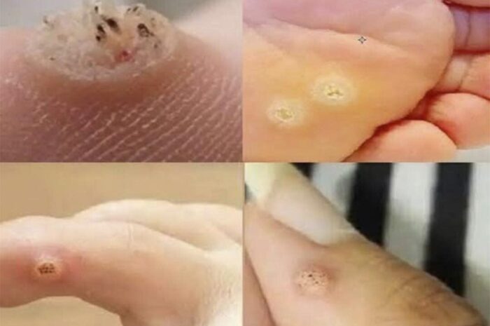 ¡MUCHO CUIDADO! Identifica y Combate las Verrugas con Remedios Naturales