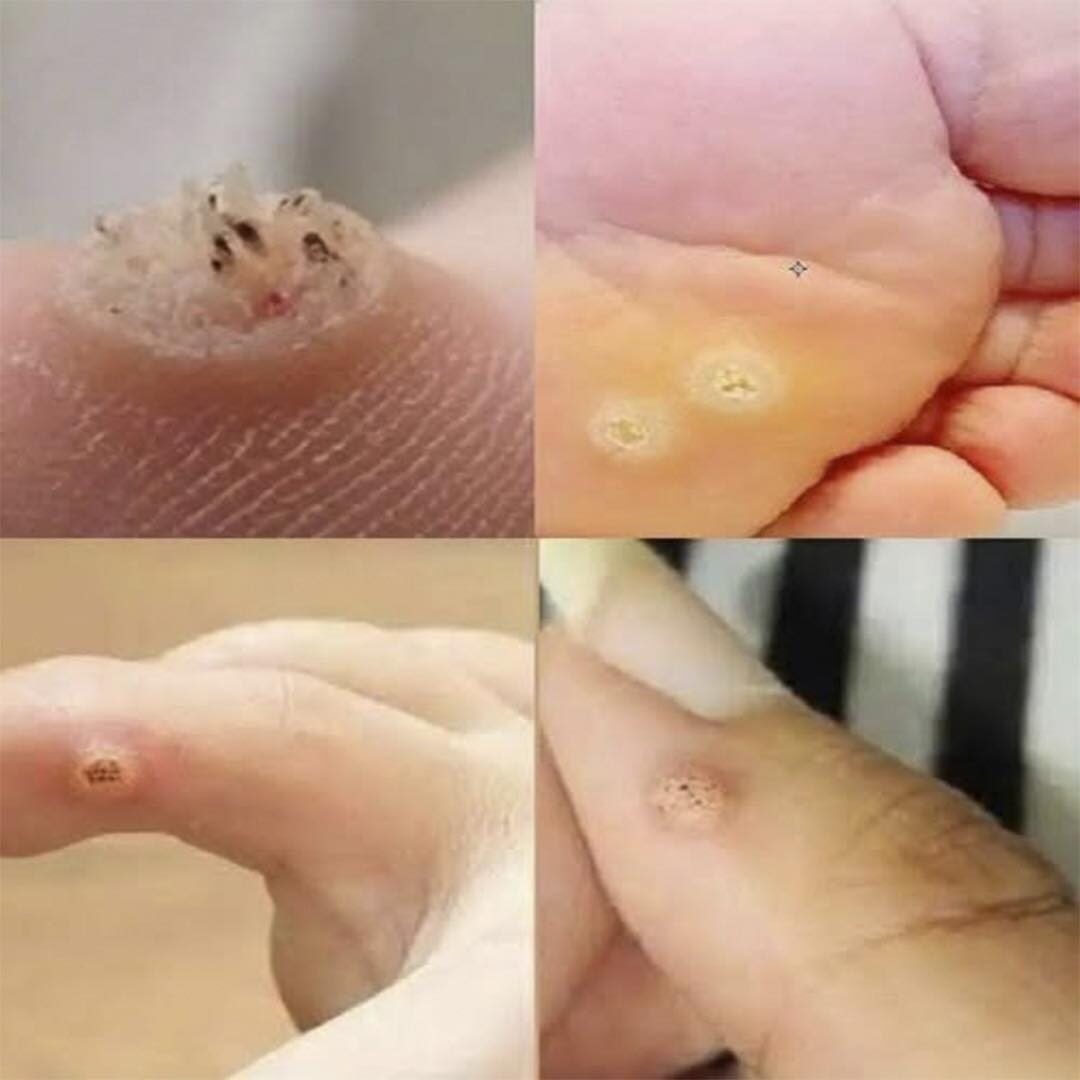 Verrugas en la piel