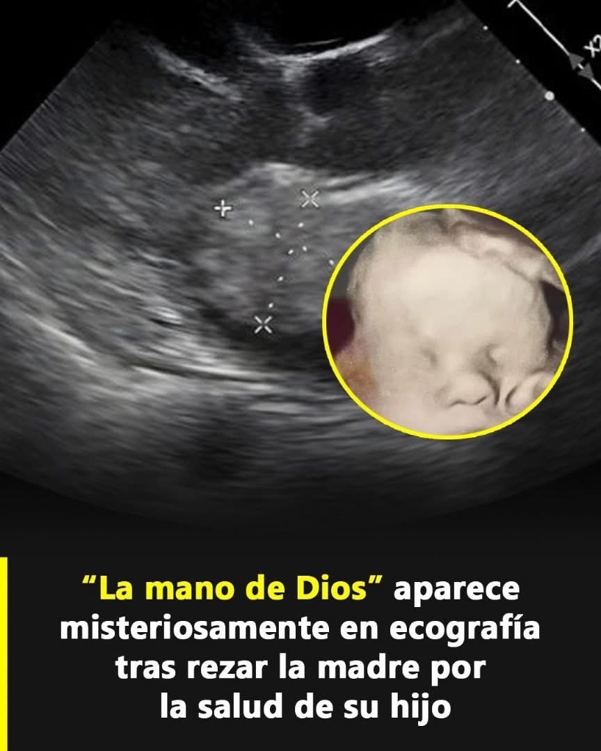 Ecografía mostrando la mano de Dios