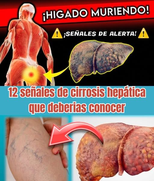 Señales de cirrosis hepática