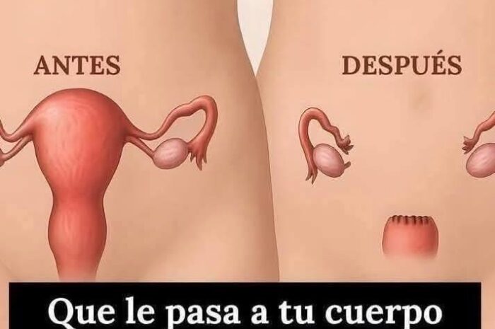 Efectos Secundarios de la Histerectomía: Lo que Debes Saber