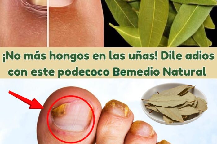 Dile Adiós a los Hongos con Este Poderoso Remedio Natural