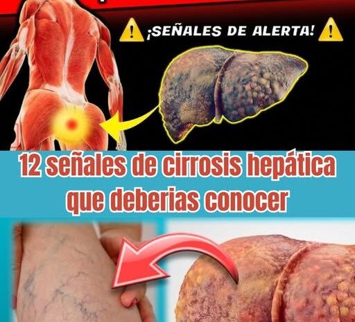¿Está Tu Hígado en Peligro? 12 Señales de Cirrosis Hepática que No Deberías Ignorar