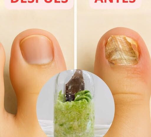 ¡Adiós a los Hongos! Remedio Casero Antimicótico para Pies y Uñas