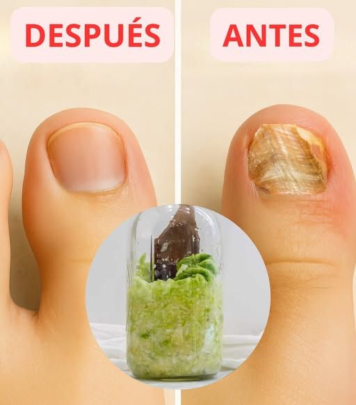 Antes y después de tratamiento de hongos en uñas