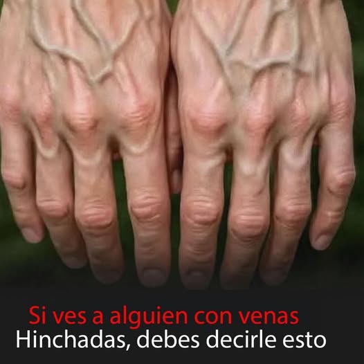 Venas visibles en las manos