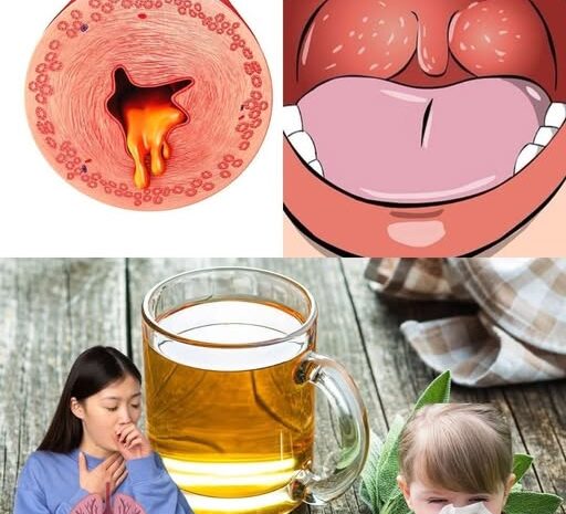 Remedios Herbales para Eliminar la Mucosidad de la Nariz, la Garganta y los Pulmones en Dos Días