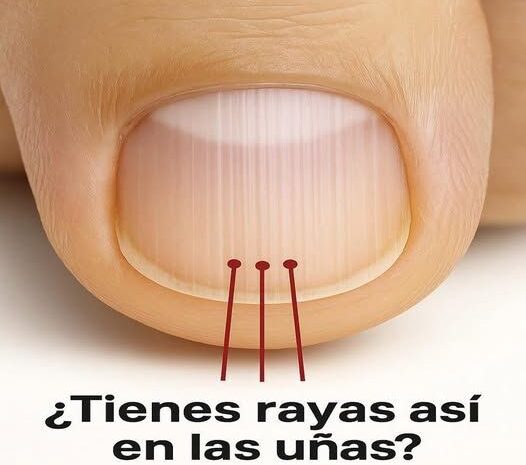Rayas en las Uñas: ¿Qué Significan y Cómo Afectan Tu Salud?