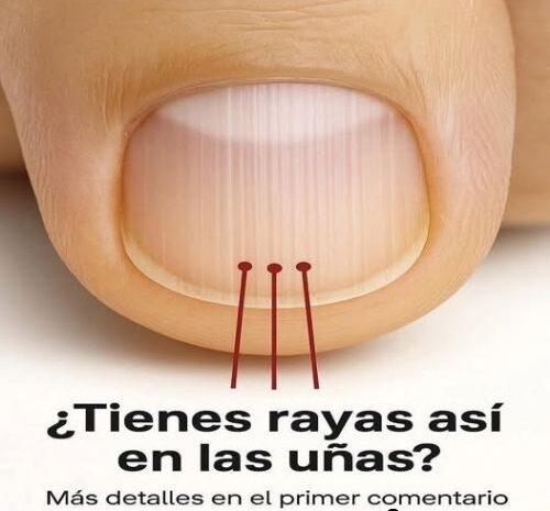 Rayas en las Uñas: Signos de Salud y Remedios Naturales