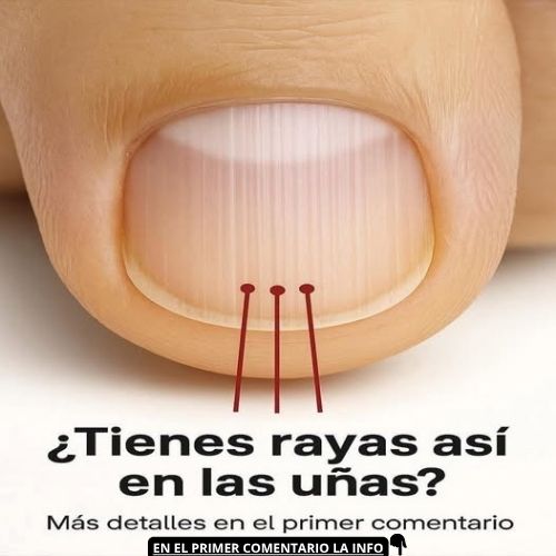 Rayas verticales en las uñas