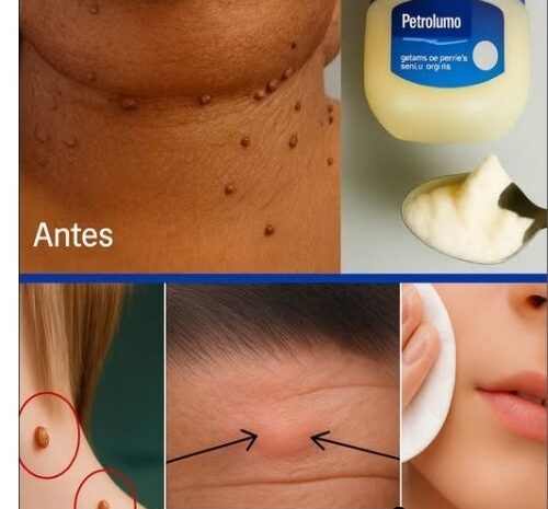 Remedio Casero con Vaselina para las Verrugas: Solución Natural para Tu Piel
