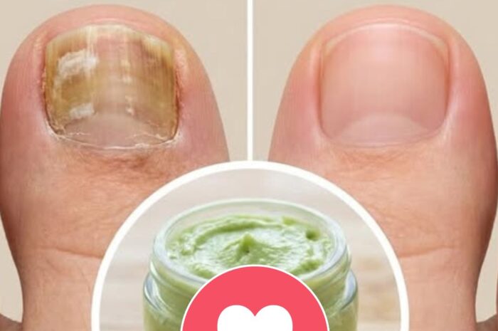 ¡Adiós a los Hongos! El Remedio Casero Antimicótico que Transformará tus Pies y Uñas