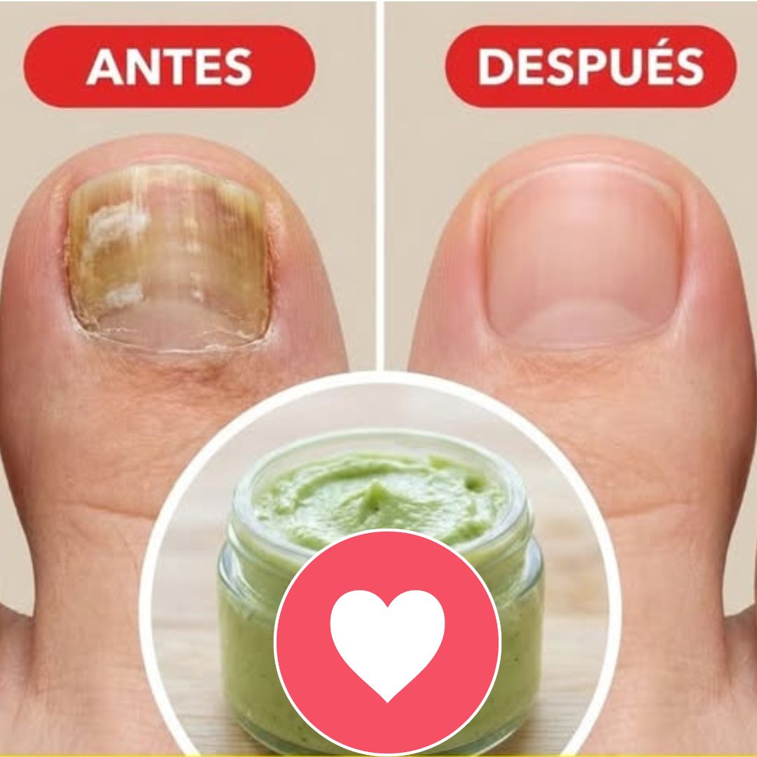 Remedio casero antimicótico