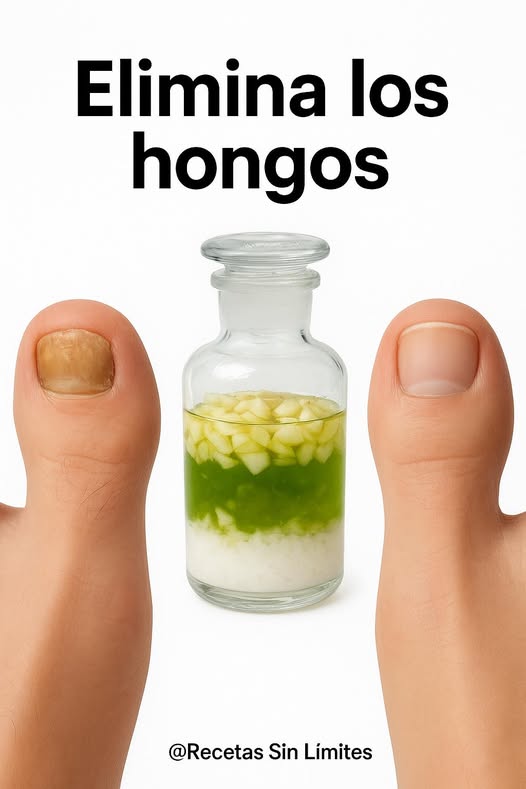 Remedio Natural para Hongos en las Uñas