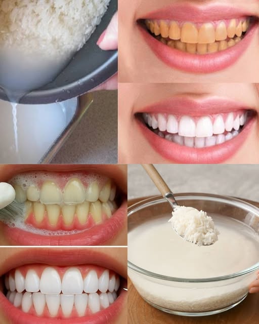 Proceso de Blanqueamiento Dental con Agua de Arroz