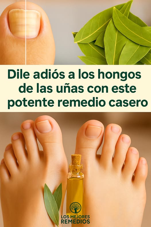 Remedio natural con hojas de laurel para hongos en las uñas