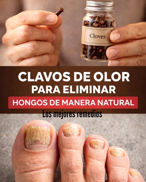 Clavos de Olor para Eliminar Hongos de Manera Natural