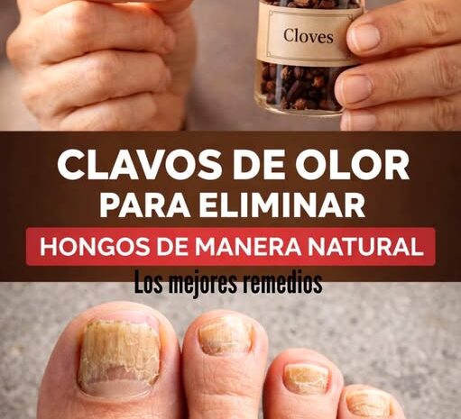 Remedio Natural con Clavos de Olor para Eliminar Hongos en las Uñas