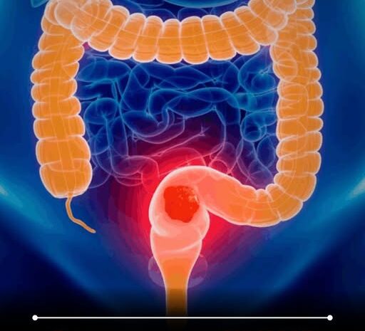 Cinco Alimentos Que Mejoran La Salud Del Colon