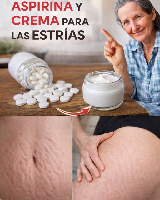 Aspirina y crema para el tratamiento de estrías