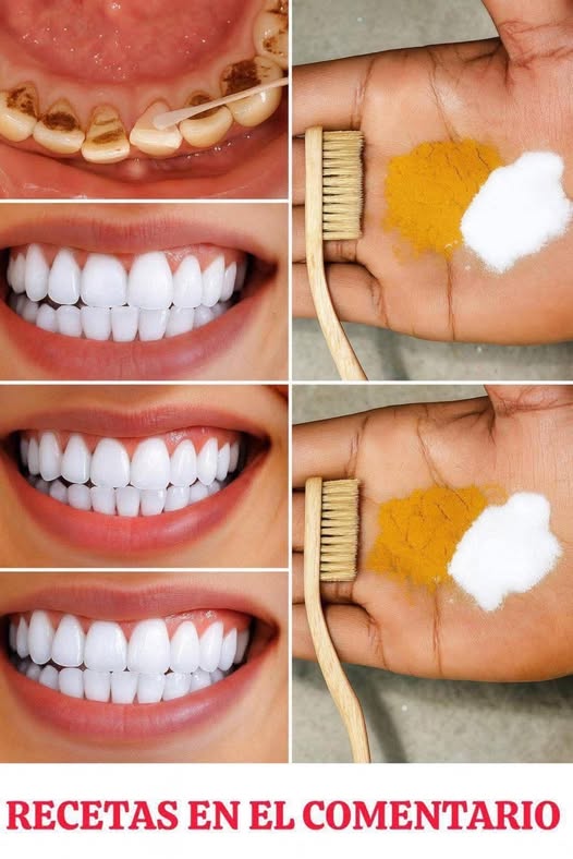 Transformación Dental - Blanqueamiento Casero