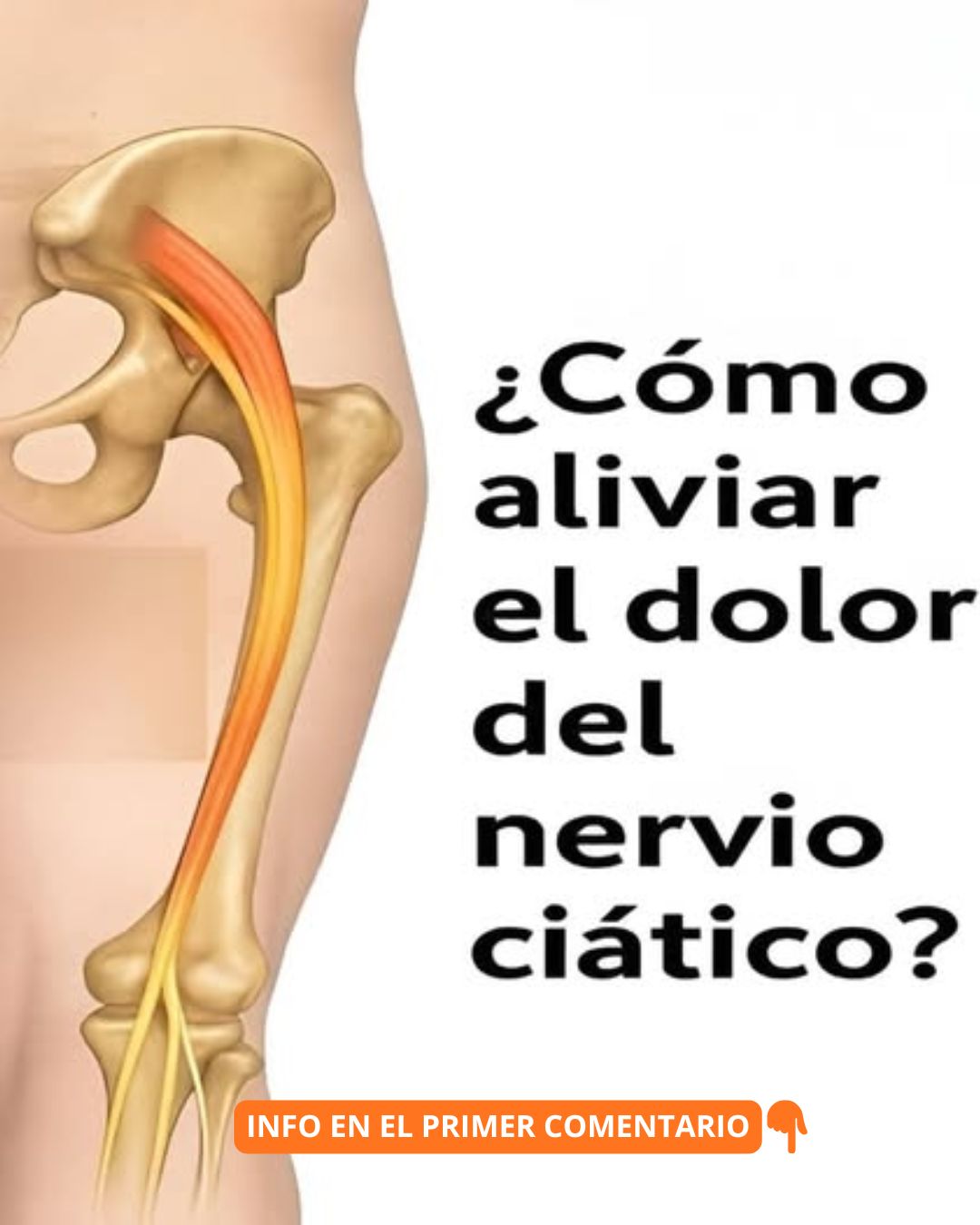 Ilustración del cuerpo humano mostrando la ubicación del nervio ciático