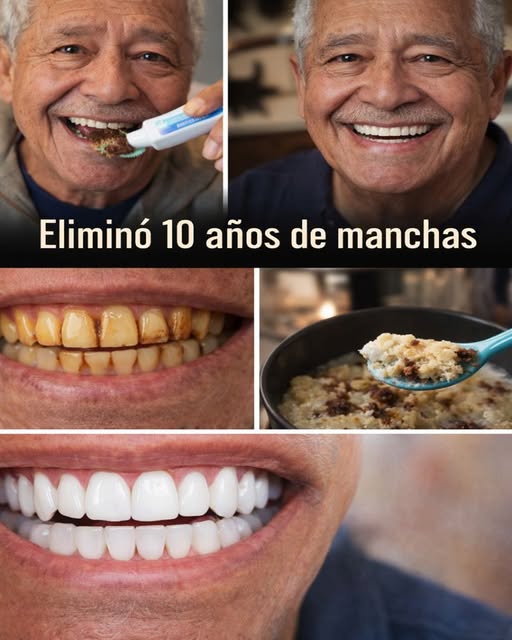 Antes y Después del Blanqueo Dental Natural