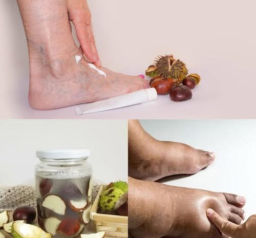 Castaño de Indias Un Remedio Natural Para Piernas Hinchadas y Mala Circulación