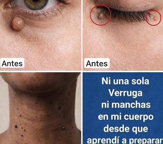 Tratamiento Natural Casero para Verrugas con Ajo y Aceite de Coco