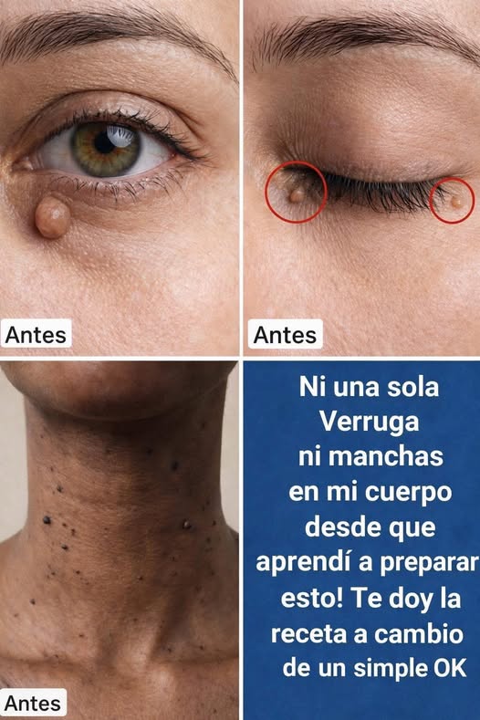 Tratamiento casero para verrugas