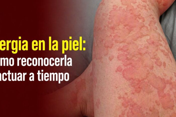Alergia en la piel: Cómo reconocerla y actuar a tiempo