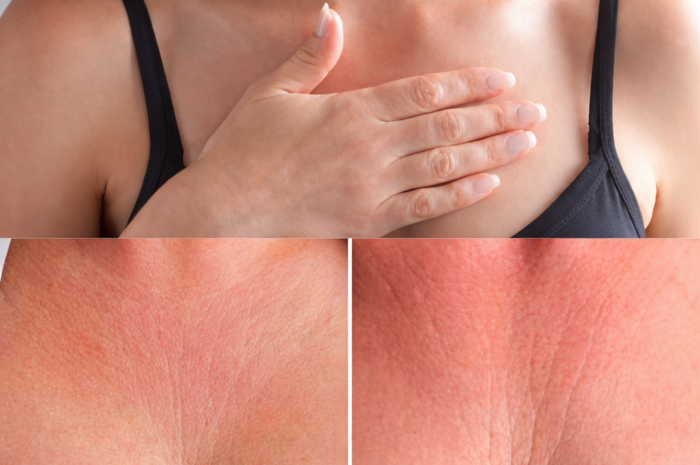 Arrugas del escote: cómo prevenirlas y mejorar su apariencia