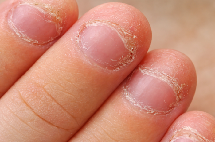 Onicofagia: qué es y cómo dejar de morderse las uñas