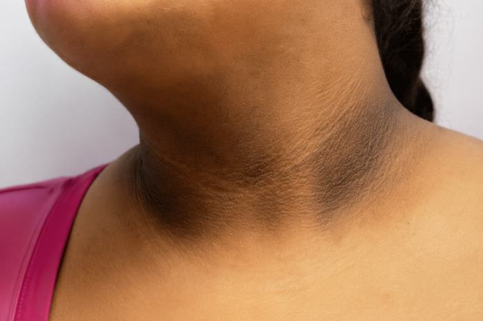 Manchas oscuras en pliegues del cuerpo: Causas
