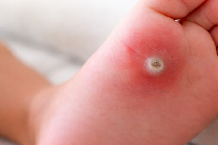 Ojo de pescado en los pies: qué es y cómo diferenciarlo