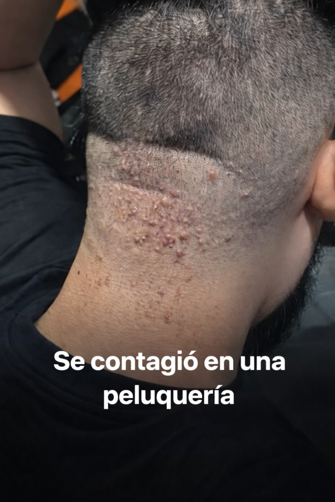Infección tras un corte de cabello: cómo prevenir la foliculitis