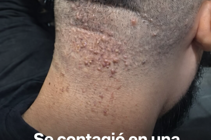 Infección tras un corte de cabello: Cómo prevenir la foliculitis