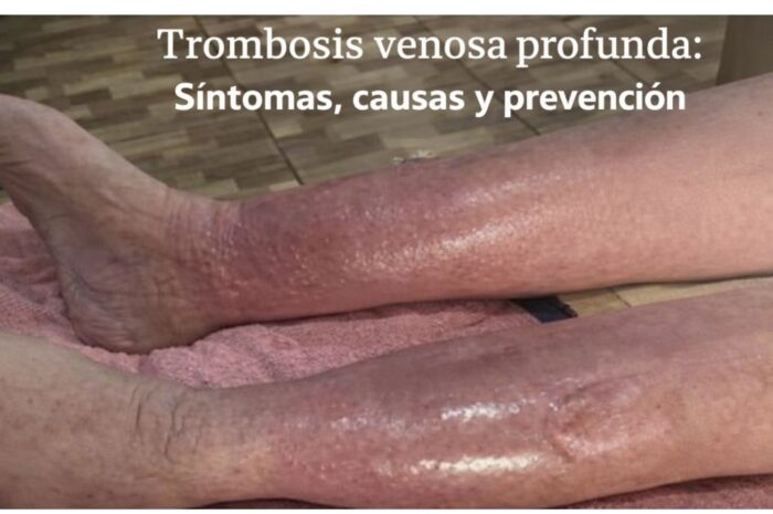 Trombosis venosa profunda: Síntomas, causas y prevención