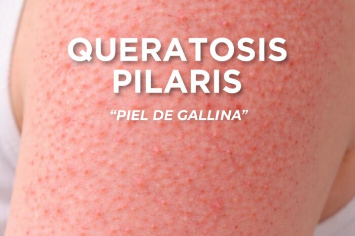 Por qué aparecen los puntitos ásperos en la piel y cómo mejorarlos